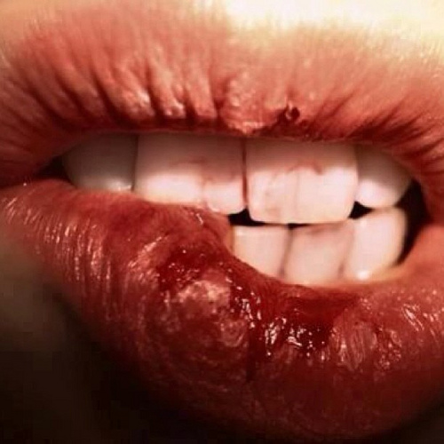 Chapped Lips: Symptoms, Causes & Risk Factors