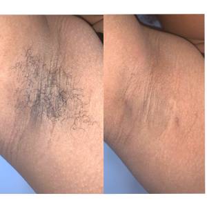 hair removal in armpits